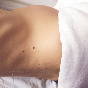 Pregnancy Acupuncture